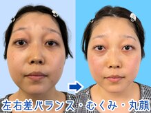 ナチュラルパーフェクトフェイス 新宿/むくみ・目の下のクマ/新宿小顔