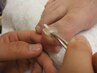 【巻き爪矯正】地域最安級に挑戦！穴をあけないプレート補正　　1本 ￥6000