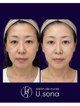 小顔・脂肪コントロール専門 salon de nurse U.sona～松本店～/【顔造形】50代脂肪増殖症例