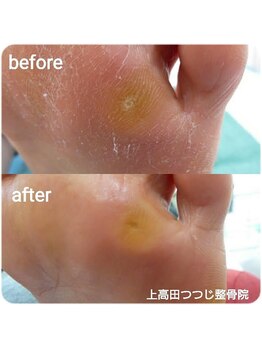 上高田つつじ整体院/魚の目　フットケア