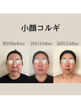 リーブル(LIBRE)/小顔コルギ 3回