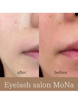 モナ(MoNa)/お顔パーツWAX脱毛