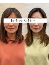 長寿鍼灸院 長寿整骨院/美容鍼50本の効果★（6回目）