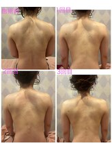 プリマヴェーラ(PRIMAVERA)/背中4回施術後の変化
