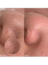 グレーシス(Graces)/小鼻の黒ずみ角栓一度ですっきり