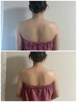 ブリランテ(Brillante)/体験beforeafter背中
