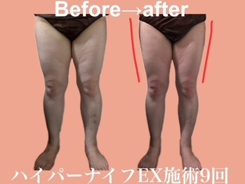 エステサロン ヴリエ 立川店/★ハイパーEX下半身60分★9回