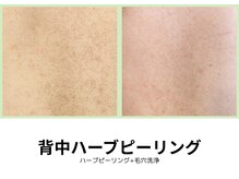 シェリール(Cherir)/背中ハーブピーリング