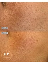 アエ(ae)/スポットクリア