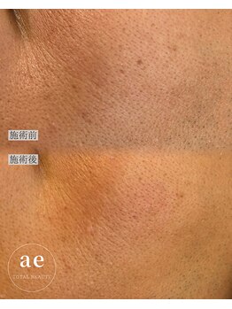 アエ(ae)/スポットクリア