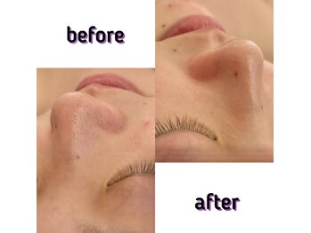 パルティール 銀座店 partir/ハイドロ毛穴洗浄１回の効果！