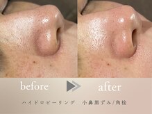 グロッシー(glossy)/【症例】小鼻皮脂詰まり黒ずみ