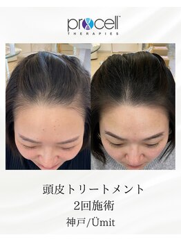 ユミト(Umit)/プロセルスカルプ