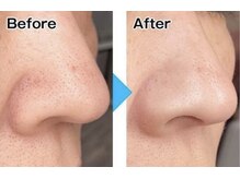 ミタス(Me+)/ごっそり毛穴洗浄♪