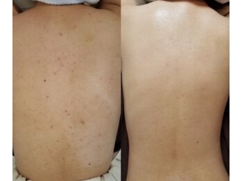 チュチュ(TUTU)/夏前に始めるのが◎