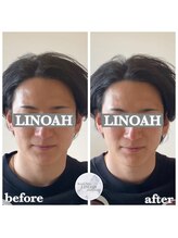 リノア 心斎橋店(LINOAH)/ウルトラプラス小顔リフト b→ a