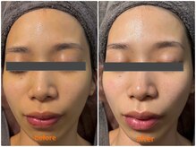 シロ(CHILO)/水光ピーリング＋美容液導入