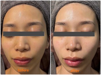 シロ(CHILO)/水光ピーリング＋美容液導入