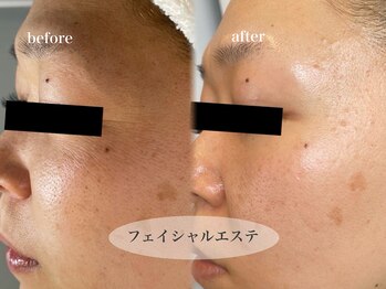 ビジュー(bjyou)/フェイシャルエステ