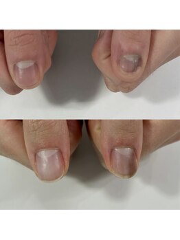 エスネイル(S-nail)/深爪矯正/自爪育成