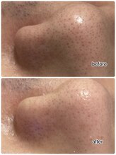 エンチャント(ENCHANT)/★メンズハイドラ毛穴洗浄