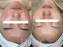 リツ(Ritsu)/赤み/ピリつき/敏感/火照り