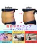【イチオシ★人気No,1】脂肪冷却4カップ+しっかりキャビラジセット40000→