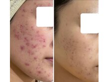 ハクビューティー(HAKU BEAUTY)/ニキビケア