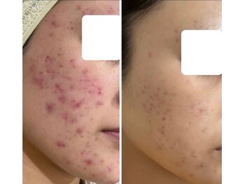 ハクビューティー(HAKU BEAUTY)/ニキビケア