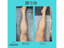 アクト クロ(ACT curro)/【脚全体】脱毛施術例