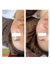 ヴィヴ コレビ(VIV COREBI)/月1の陶肌トリートメントで美肌