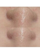 マイフェアレディ 今池(MyFairLady)/毛穴洗浄★ハイドロフェイシャル