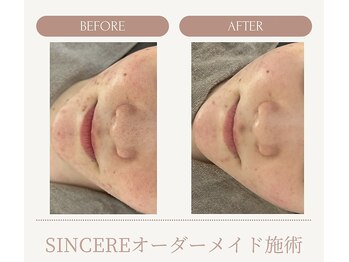 シンシア(SINCERE)/オーダーメイド肌改善プログラム