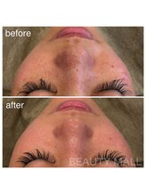 ビューティーモール(BEAUTY MALL)/シミスポット