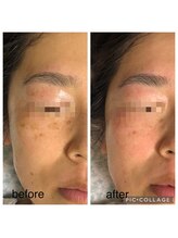 エスカル ボーテ(escale beaute)/シミケア