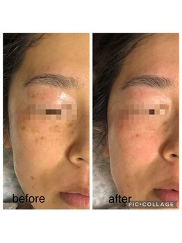 エスカル ボーテ(escale beaute)/シミケア