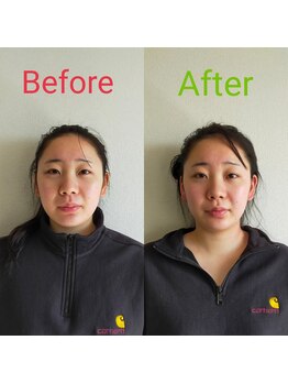 シャルム(Charme)/小顔矯正＋全身美容整体施術１回