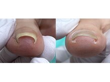 練馬フットケアセンター/◆痛みの少ない巻き爪補正☆