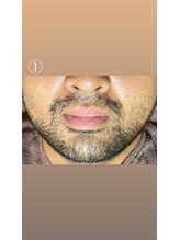 エステサロン桜/毎日の髭剃りから解放されます！