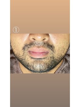 エステサロン桜/毎日の髭剃りから解放されます！