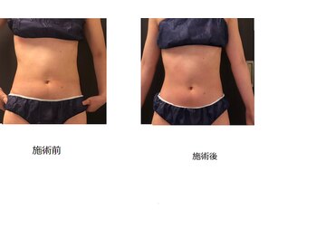 ヴィータサナ(Vita-Sana)/◆お腹引締め◆1回でも効果◎