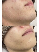 カルディエ(Cardie)/ひげ脱毛　カミソリ荒れ改善