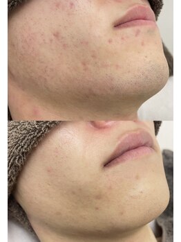 カルディエ(Cardie)/ひげ脱毛　カミソリ荒れ改善