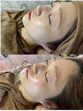 マホロバ(mahoroba)/ララピールビフォーアフター