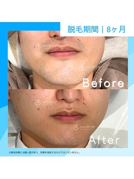 メンズクリア 西葛西店/【メンズクリア】お客様の施術例