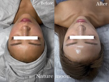 ナチュールムーン(Nature moon.)/ハーブピーリング