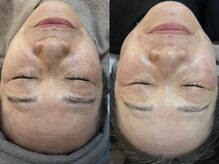 ビーマジック(Be Magic)/毛穴/脱毛/小顔/シェービング/眉