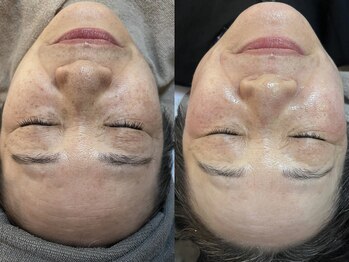 ビーマジック(Be Magic)/毛穴/脱毛/小顔/シェービング/眉