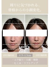 ユウサク(Yusaku)&nbsp;小顔 矯正