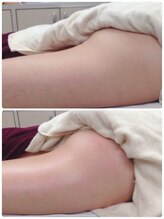 サロン ド チョコ(SALON DU CHOCO)/【痩身】症例